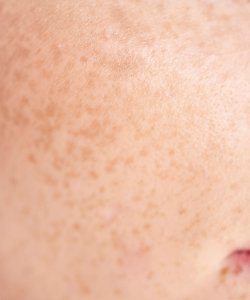 Focus on face skin Focus on face skin